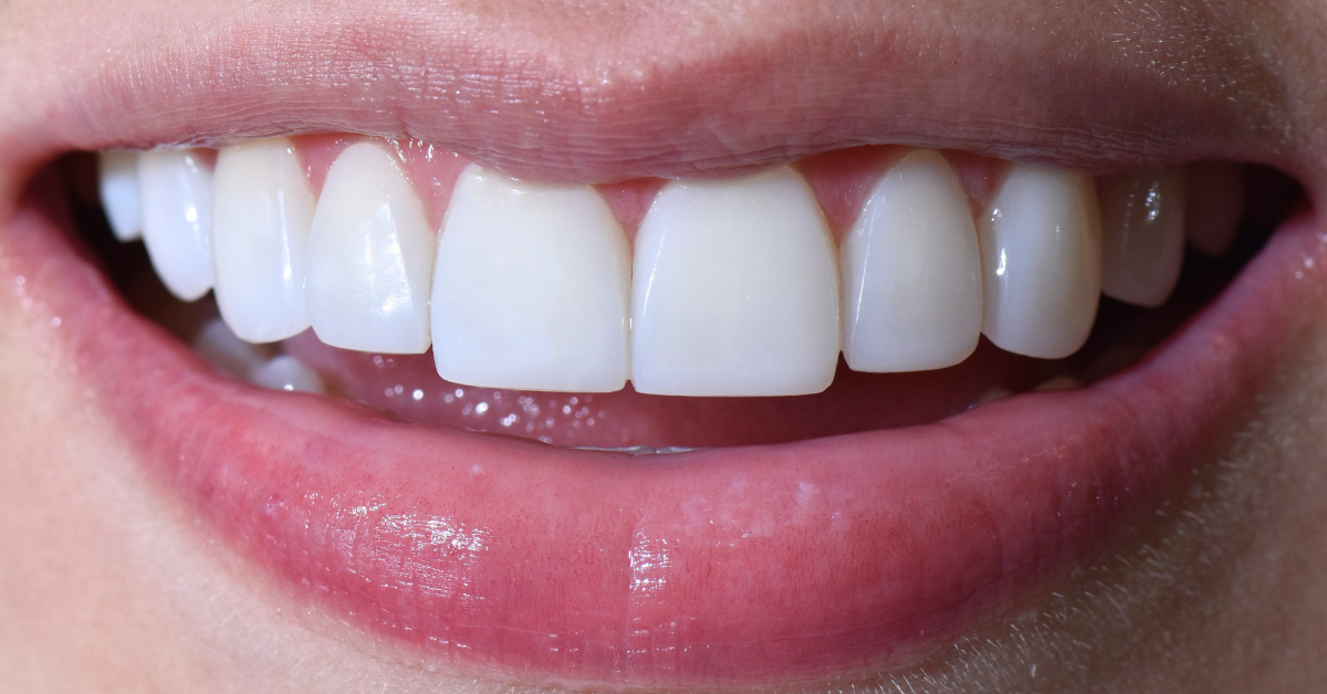 Carillas en resina para diseño de sonrisa natural