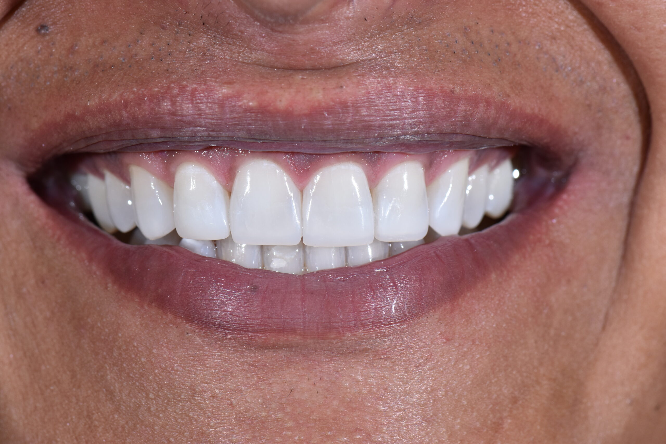 Diseño de sonrisa con bordes estéticos, antes y después