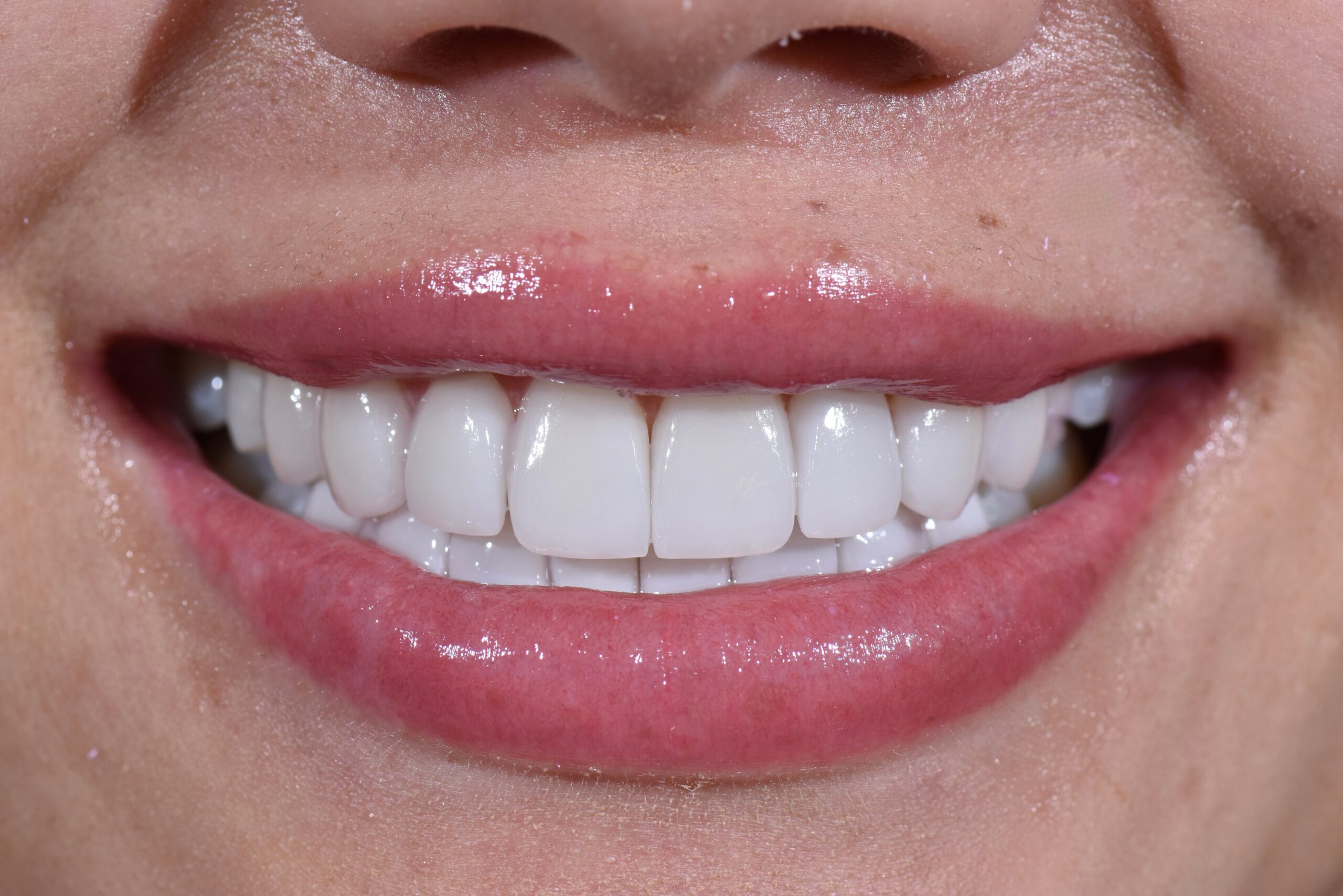 Carillas en cerómero para diseño de sonrisa